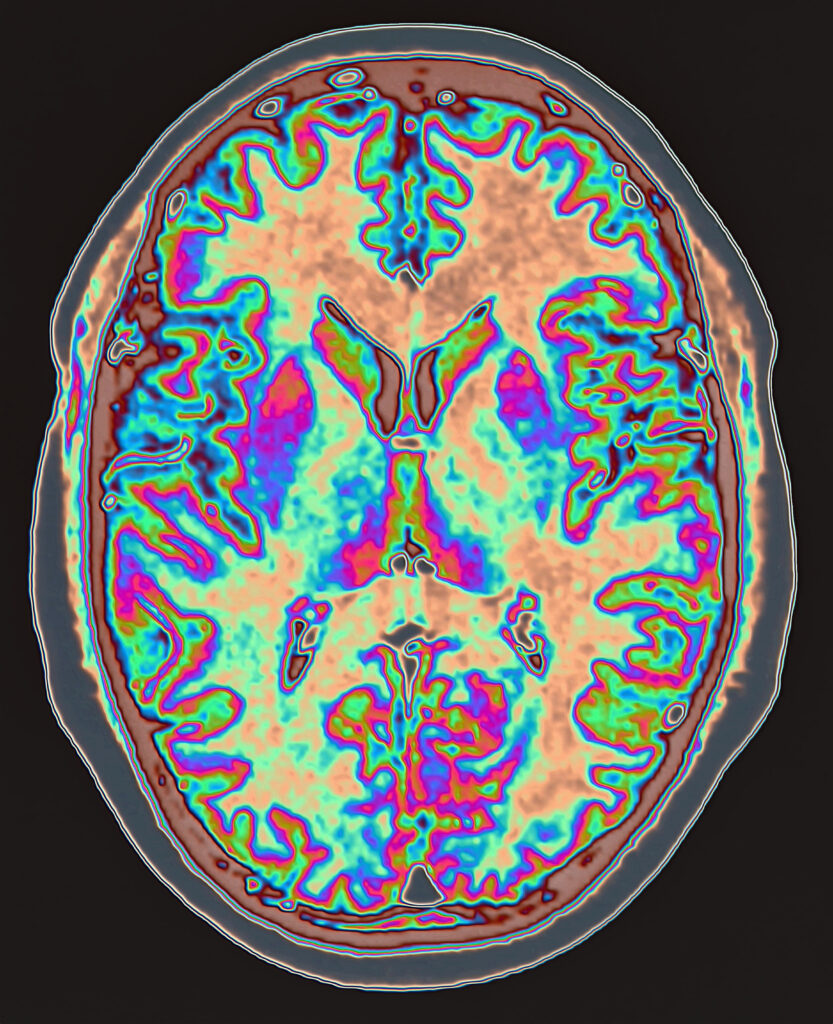 National Institute of Neurological Disorders and Stroke Awards $3.8 Million to Cleveland Clinic Researcher to Predict Dementia in Parkinson’s Disease Patients